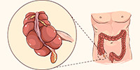 Diagnose appendicitis