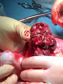 Peroperatief beeld van de abdominale tumor