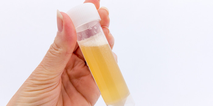 urine-onderzoek