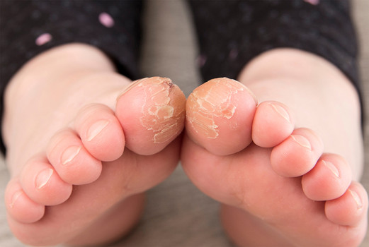 Close up van voeten met juveniele plantaire dermatose
