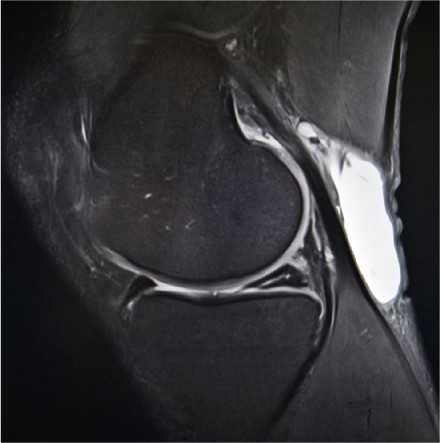 Koninklijke familie Gemakkelijk rukken MRI-knie bij iedere patiënt met acuut knietrauma niet kosteneffectief |  Huisarts & Wetenschap