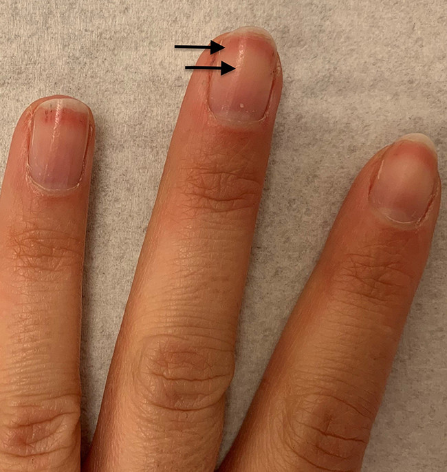 Bijdrage Scheermes samenkomen Rode randen onder de nagels | Huisarts & Wetenschap